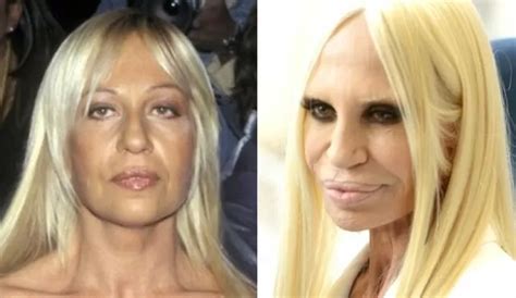 antonella versace prima e dop